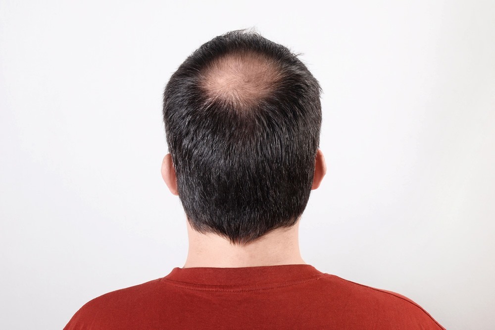 Testosterone Replacement Therapy Side Effects to Watch Out For